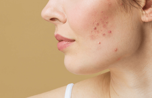 Acne in people of color