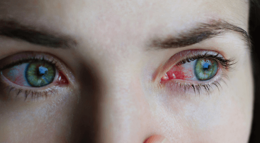 causes and treatment of red eyes
