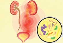 Diseases and Infections of the Urinary System