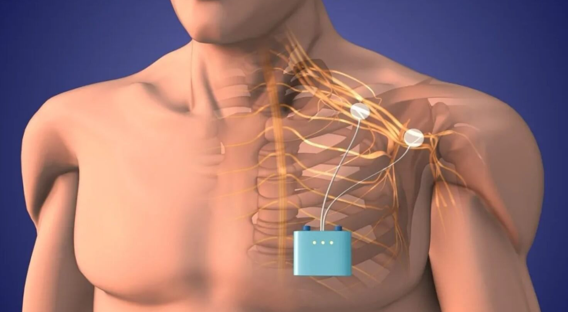 Spinal Cord Stimulation Doctors in St. Pete Florida
